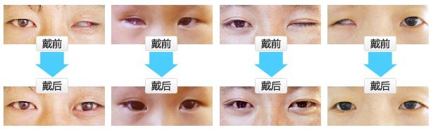 护理义眼的4个注意事项