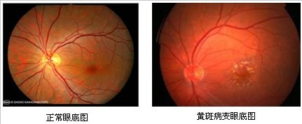 眼底黄斑病变的治疗方法