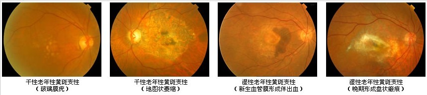 黄斑病变的病因是什么