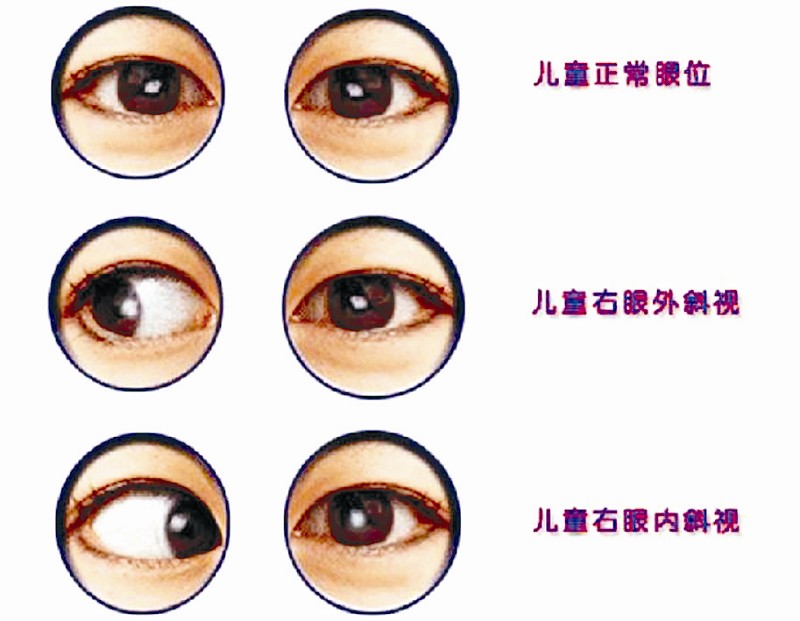 为什么小孩子眼睛会斜视?