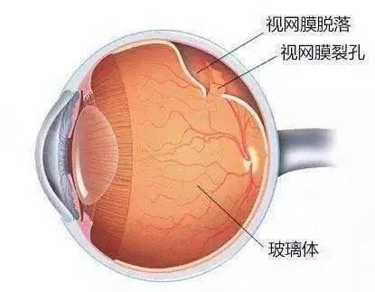 什么是视网膜脱离？