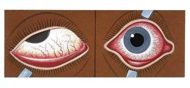 眼睛分泌物增多是怎么回事？