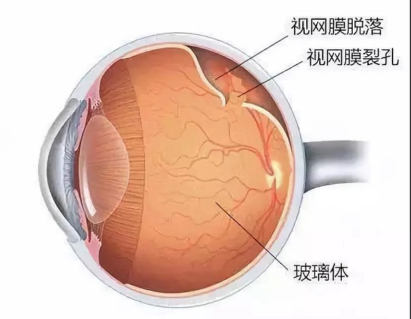 视网膜脱落的症状是什么能不能完全治好上海和平眼科告诉你