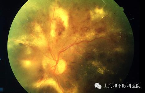 高度近视易发生眼底病变