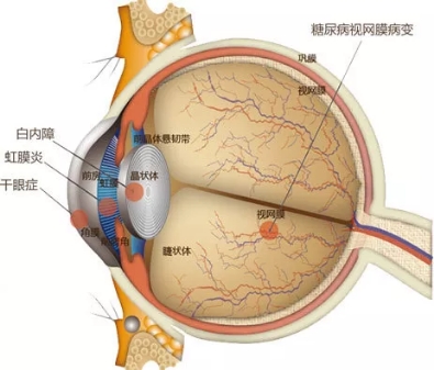 吸烟会增加患糖尿病视网膜病变的风险吗？