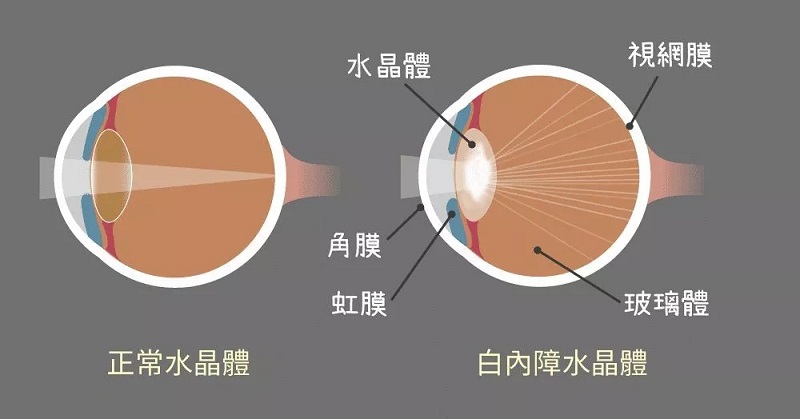 白内障眼睛示意图