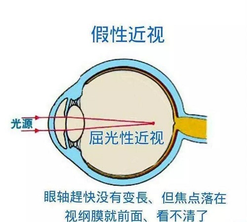 什么是假性近视？