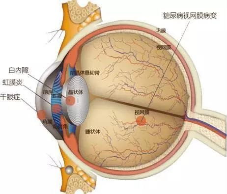 糖网病有哪些症状？