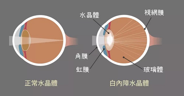 每个人都会得白内障吗？