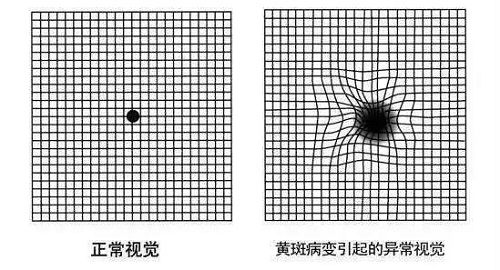 如何自测是否患有黄斑变性？