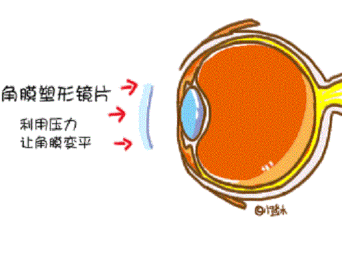角膜塑形镜矫正近视的原理