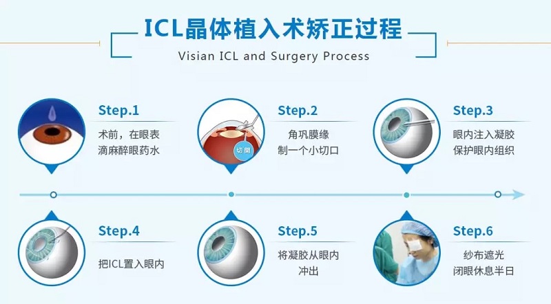 ICL晶体植入术手术流程