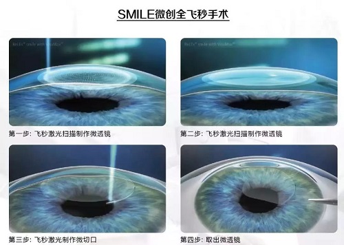 全飞秒激光近视手术好吗？