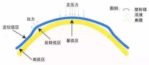 青少年配镜，该选择什么样的框架？