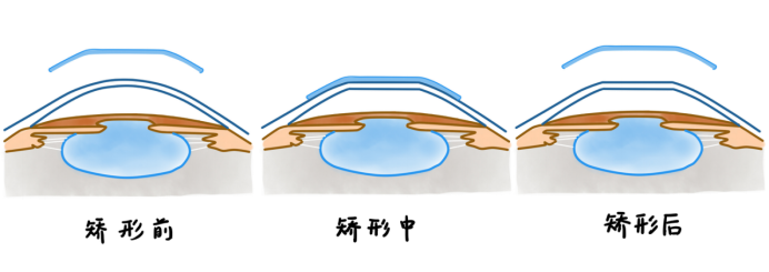 如何正确佩戴角膜塑形镜？