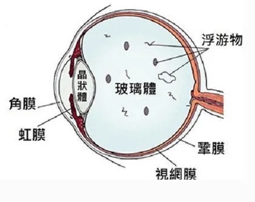 得了飞蚊症有必要治疗吗？