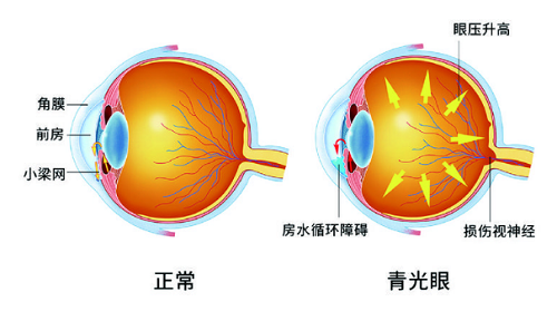 头疼有可能是青光眼在发作