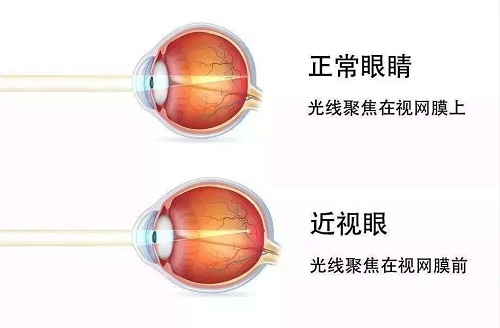 近视可以不戴眼镜吗？
