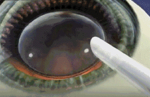 近视手术可以矫正散光吗？