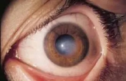 什么是角膜白斑？