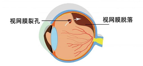 哪些人容易发生视网膜脱落？