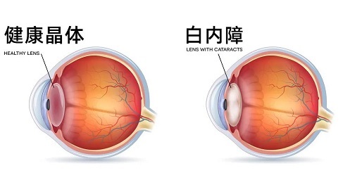 白内障的防与治