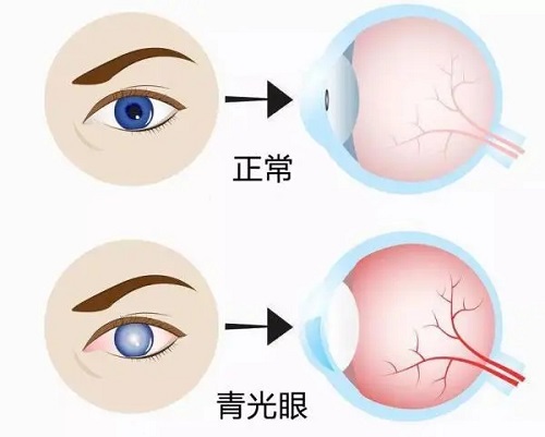 更年期女性容易得青光眼吗？