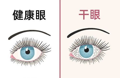干眼怎么治疗好？