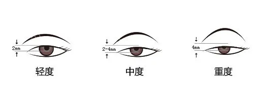 眼睛小是上睑下垂造成的吗？