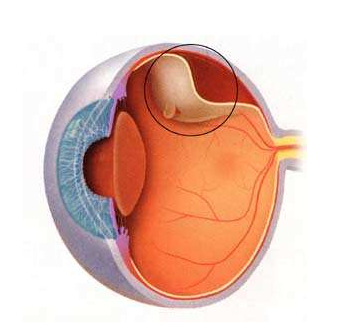 视网膜脱离会导致失明吗？