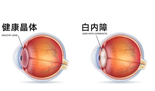 哪些眼病会遗传给下一代？