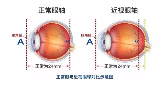 近视原理