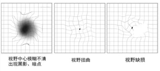 黄斑变性