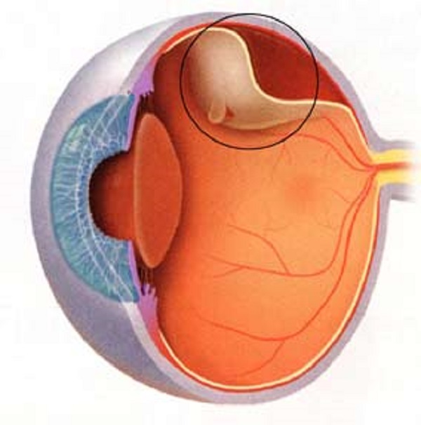视网膜脱落,视网膜脱离,眼底病