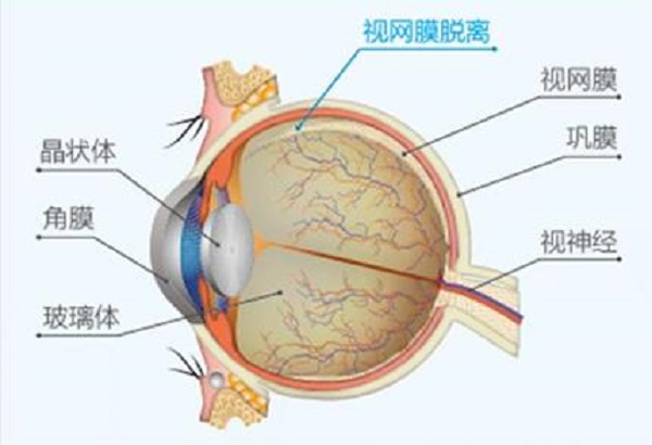 视网膜脱落,视网膜脱离,眼底病