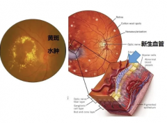 警惕糖尿病“偷走”视力