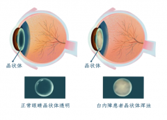 【科普】白内障手术如何