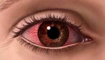 symptom 1玻璃体出血你的玻璃体会出现这些症状正常的玻璃体具有一定